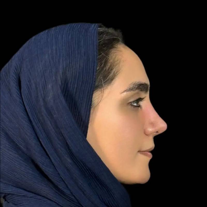 رینوپلاستی (مشاوره و جراحی بینی)