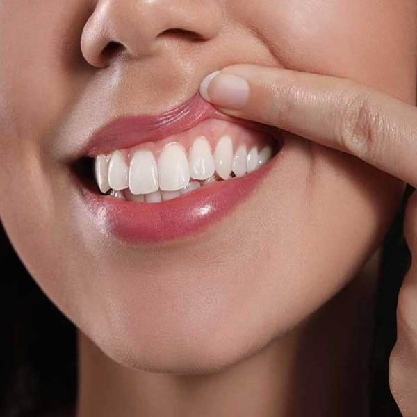 با تزریق تخصصی لبخندت رو زیباتر کن / لبخند لثه ای