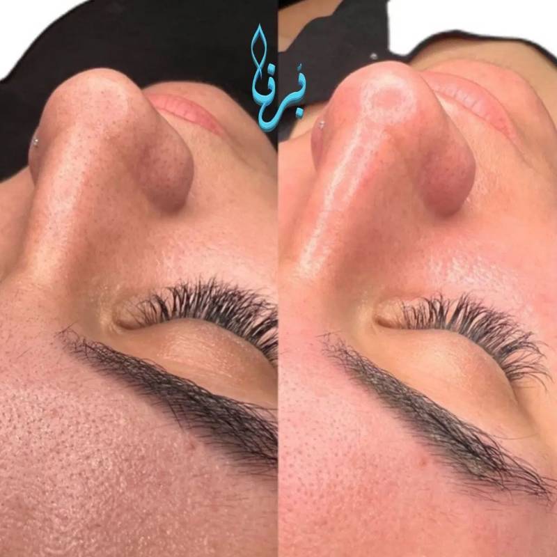 پوستی شفاف‌تر و باطراوت‌تر با/ فیشیال/