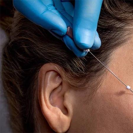 لیفت ابرو و شقیقه بدون جراحی