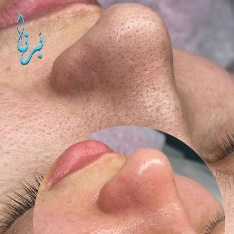 جای جوش و لک رو به پوست صاف‌تر تبدیل کن